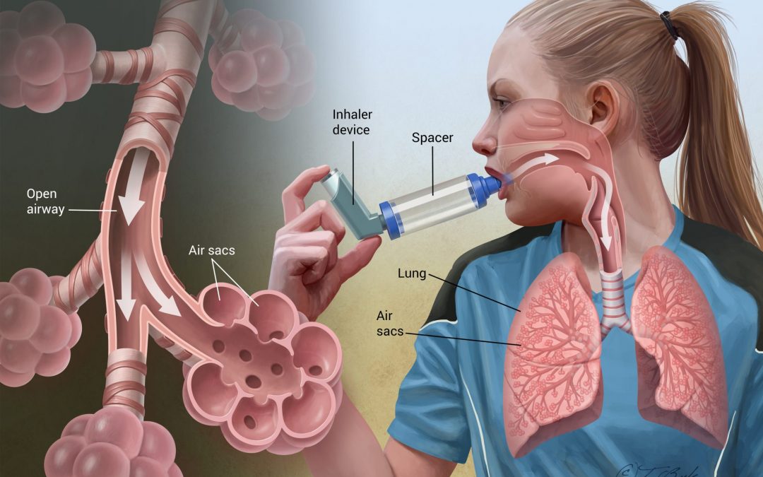 What is Asthma?