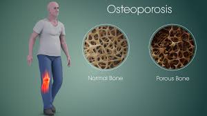 Osteoporosis??