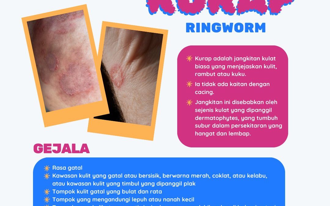 KURAP (RINGWORM)